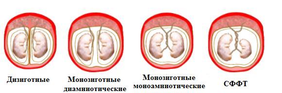 Близнецы и двойняшки: в чем разница